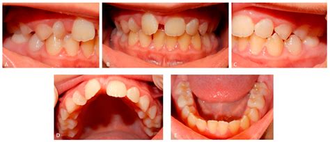 Medicina | Free Full-Text | Type I Dentin Dysplasia: The Literature Review and Case Report of a ...