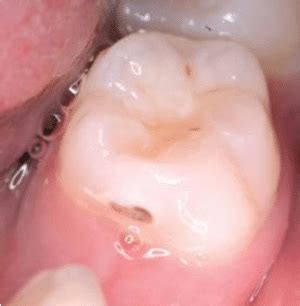 The mesial cavity on this mandibular second primary molar (75) is ...