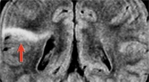 The Radiology Assistant : Role of MRI in 2020 | Mri, Epilepsy, Temporal lobe epilepsy