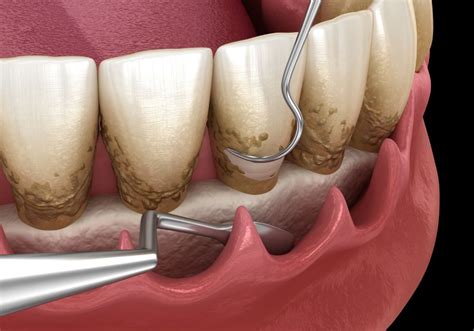 The Progressive Stages Of Periodontal Disease | Dr. Alex Midtown NYC Cosmetic Dentist
