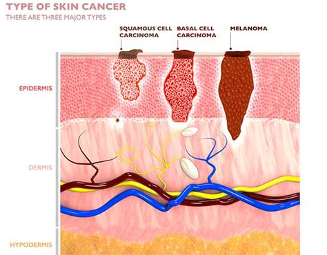 Squamous Cell Carcinoma Stages | Moffitt