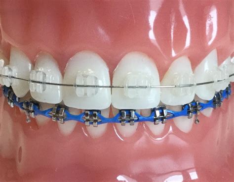 Ceramic Braces vs. Metal Braces - Sherman & Balhoff Orthodontics