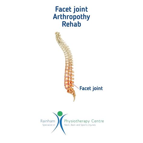 Facet Joint Arthropathy rehabilitation. – Rainham Physio