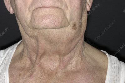 Swollen lymph node due to cancer - Stock Image - M131/0740 - Science Photo Library