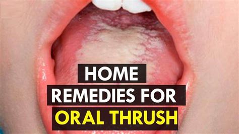 How to Treat Candida at Home | 5 Home Remedies for Oral Thrush. - YouTube