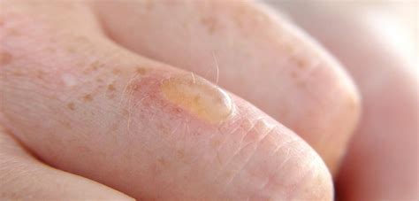 How To Cover A Burn Blister With Makeup - Mugeek Vidalondon