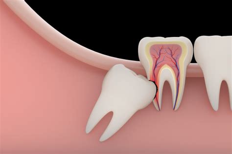 Why Would a Wisdom Tooth Extraction Be Recommended? - Simply Smiles Dentistry Tucson Arizona