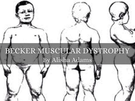 Becker Muscular Dystrophy by Alisha Afams