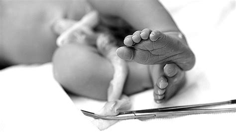 Umbilical Cord Knots: Can They Be Prevented?