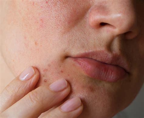 WHAT IS PERIORAL DERMATITIS? - Dr. Barbara Sturm