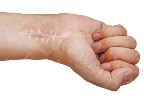 Premium Photo | Scar with stitches on the wrist after surgery Fracture of the bones of the hands ...