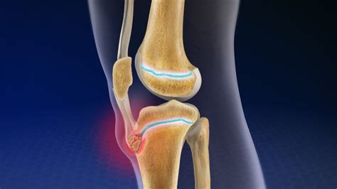 Genouillère Osgood Schlatter pour lutter contre la maladie du genou & Ultimateknees™