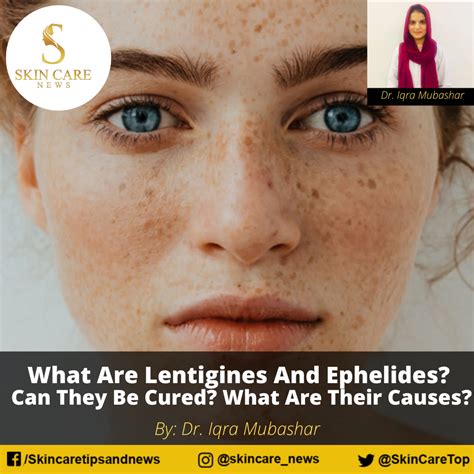 What Are Lentigines And Ephelides? Can They Be Cured?