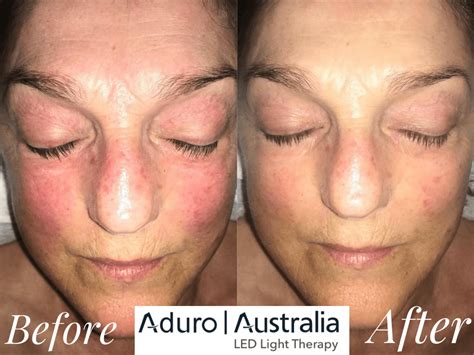 Red Light Therapy Before and After Wrinkle Treatment - Spot the ...