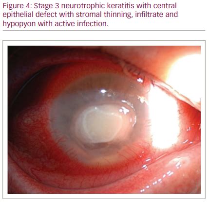 Neurotrophic Keratitis: A Review - touchOPHTHALMOLOGY