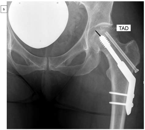 Medicina | Free Full-Text | Internal Fixation of Garden Type III Femoral Neck Fractures with ...