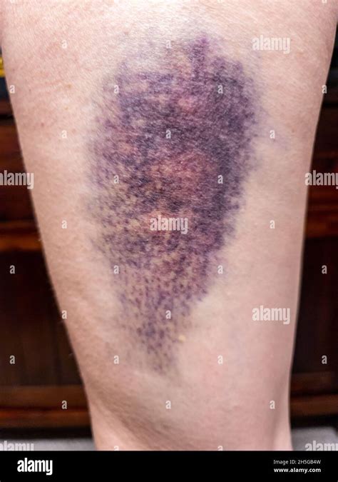 Hematoma hematoma hi-res stock photography and images - Alamy