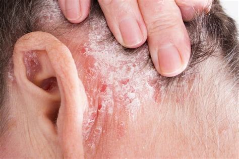 Jangan Remehkan Psoriasis, Penyakit Kulit Ini Mampu Dorong Penderitanya ...