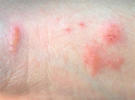 Urushiol-induced contact dermatitis - Wikiwand