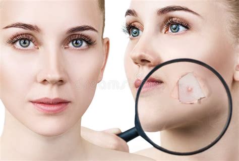 Woman Magnifying Glass Over Acne Stock Photos - Free & Royalty-Free ...