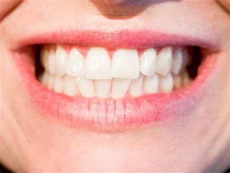 Eight Common Bite Issues That Are Corrected With Orthodontic Treatment - Rick Herrmann Orthodontics