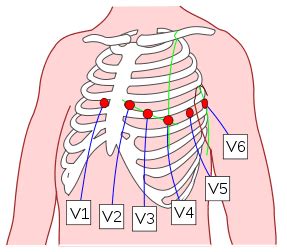 Electrodos del Electrocardiograma | ¿Donde colocarlos?