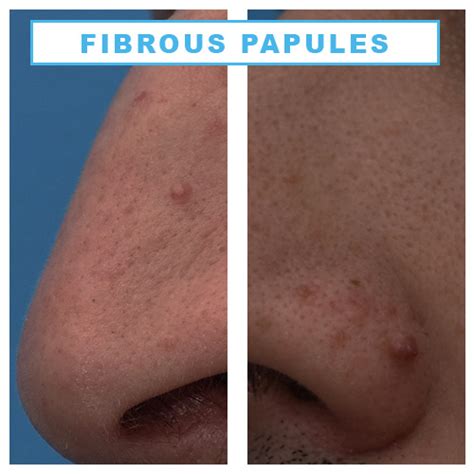 Fibrous papule | Fibrous papule of the nose | Fibrous papule treatment