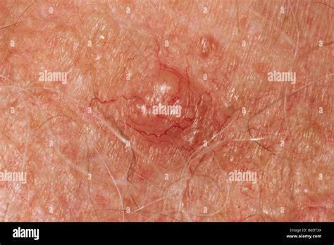 Basal Cell Carcinoma Skin Cancer Symptoms