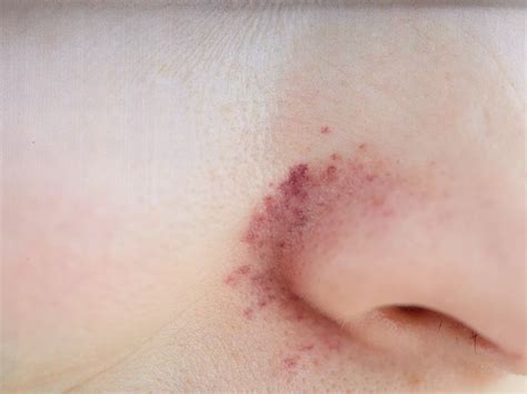 Redness around nose: Causes, treatment, home remedies, and more