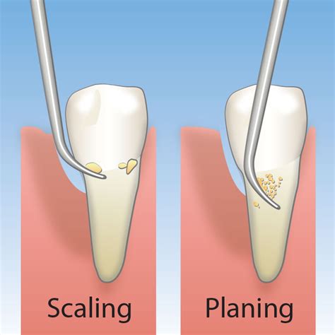 √ Scaling Dan Root Planing - Space Defense