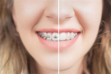 Orthodontist Braces Before And After