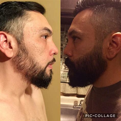 Minoxidil Before And After Beard