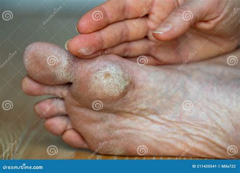 Dry Skin, Plantar Callosity and Flakes on the Female Feet Sole Close Up. Hand Applying Medicated ...