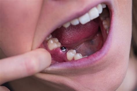 Common Signs of Dental Implant Failure and What to Do?