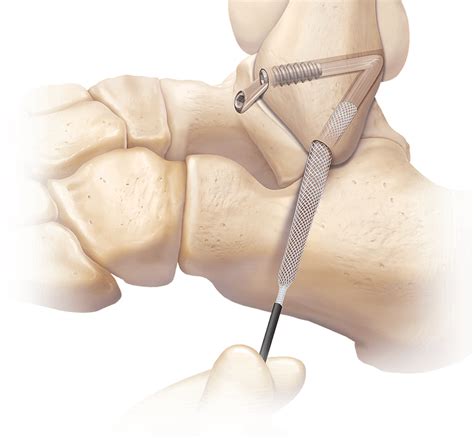 Arthrex - Lateral Ankle Ligament Reconstruction