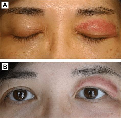 Eyelid Dermatitis