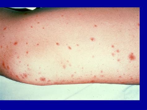 Candidiasis Skin Rash