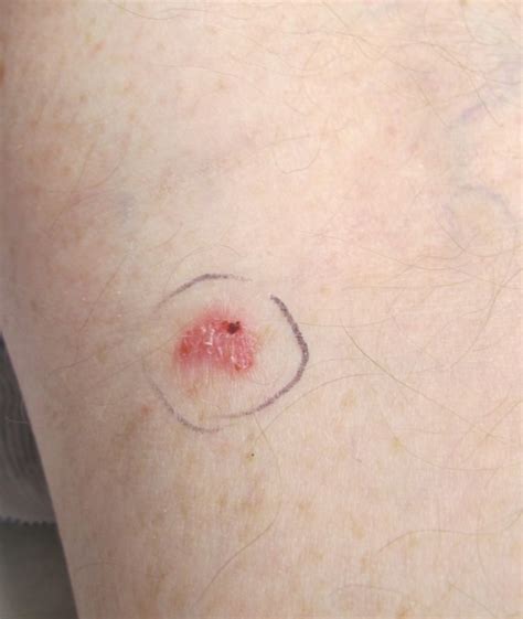 anexar Ás Picar basal cell carcinoma on leg Escreva étnico carga