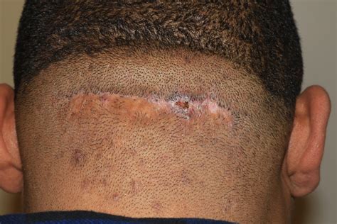 Scalp Keloids - Acne Keloidalis - Treatment with cryotherapy