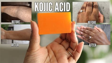 KOJIC ACID SOAP - How to lighten dark spots and get the best results - YouTube