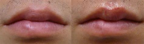 Right after Lip Coloring; He had a scar on his upper lip so we defined his lip shape and filled ...