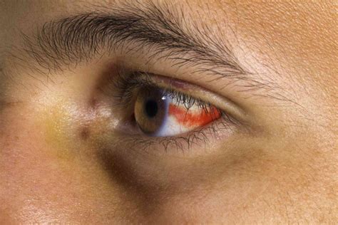 Subconjunctival Hemorrhage: Symptoms, Causes, Treatment