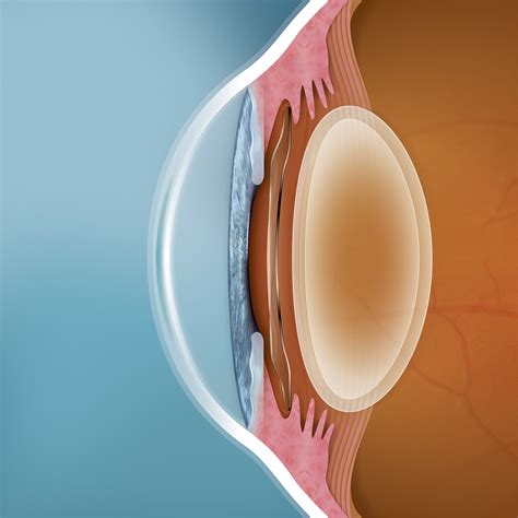 Lentes ICL: Seguridad, indoloras y cómodas. | Clínica Dr. Tirado