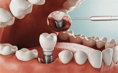 What is the best alternative for teeth implants? | Voss Dental - Oral Surgery | Implant