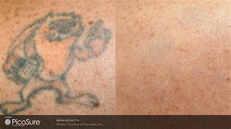 PicoSure Laser Tattoo Removal Charlotte | Ageless Remedies