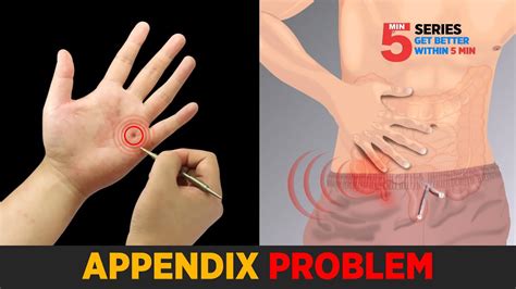 SUJOK TREATMENT FOR APPENDICITIS, APPENDIX PAIN (TREATMENT IN LEFT HAND) - The Chronic Pain ...