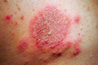 Discoid eczema - NHS