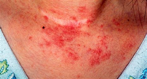 Treatment for Eczema at the Philadelphia Holistic Clinic: Dr. Tsan