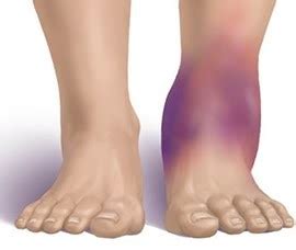 Compartment Syndrome Therapy | My Foot Clinic