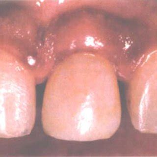 B. Non-functional post-core-crown restoration. Patient presented with ...